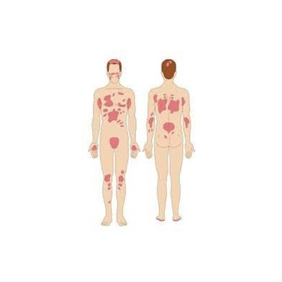 Psoriasis and seborrheic dermatitis