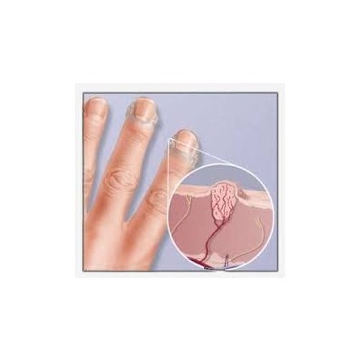 Warts and contagious molluscum