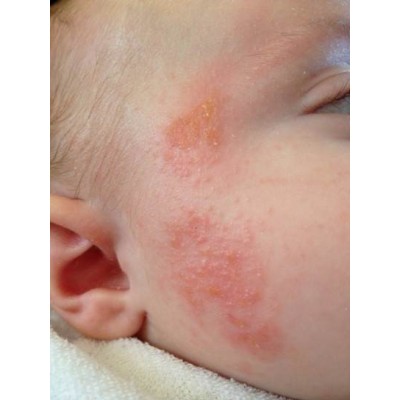 Atopic dermatitis